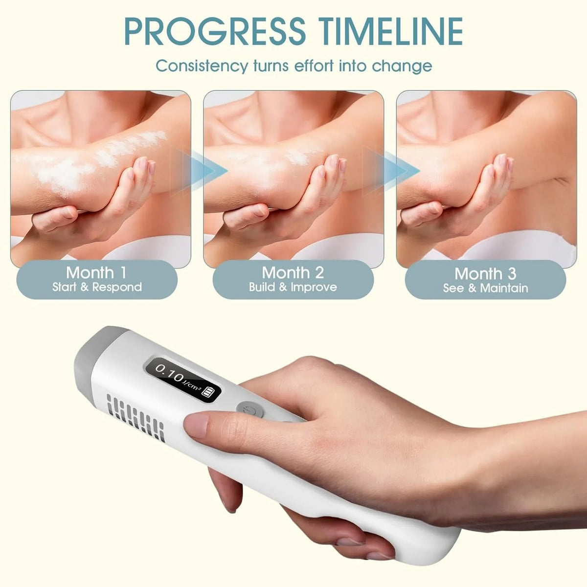 Jitesy 308nm UVB Handheld Narrowband Phototherapy Light Therapy Device
